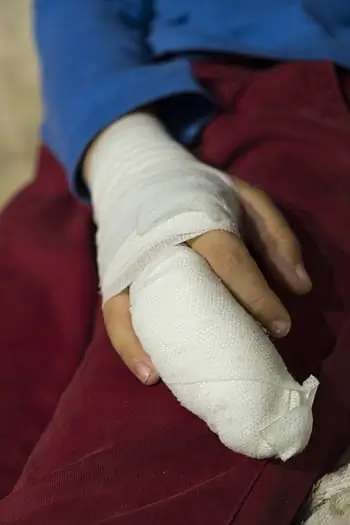 Brazo con vendaje médico blanco por una lesión de trabajo
